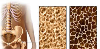 Proti osteoporozi na naraven način